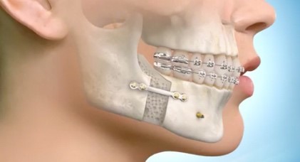 Traitement orthodontique et chirurgical